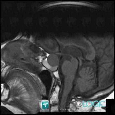 Mucocele, Pituitary gland and parasellar region, MRI