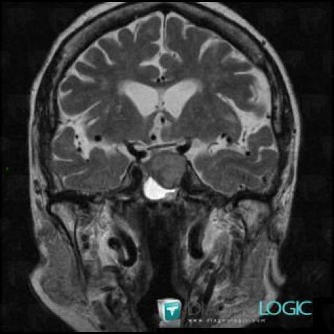 Mucocele, Pituitary gland and parasellar region, MRI