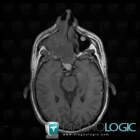 Mucocele, Sinus, IRM