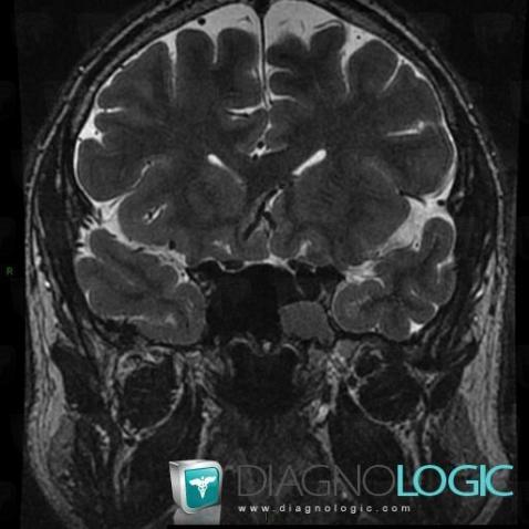 Mucocele, Sinus, MRI