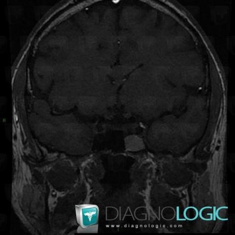 Mucocele, Sinus, MRI