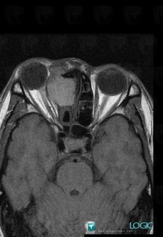 Mucocele, Sinus, MRI