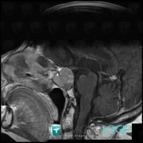 Mucocele, Sphenoid bone, MRI