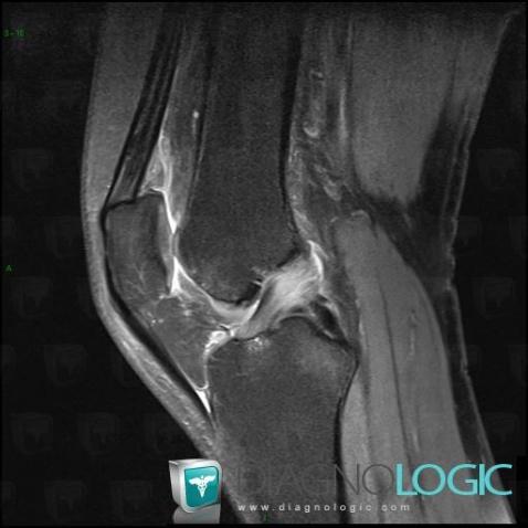 Radiology case : Subchondral cyst (MRI) - Diagnologic