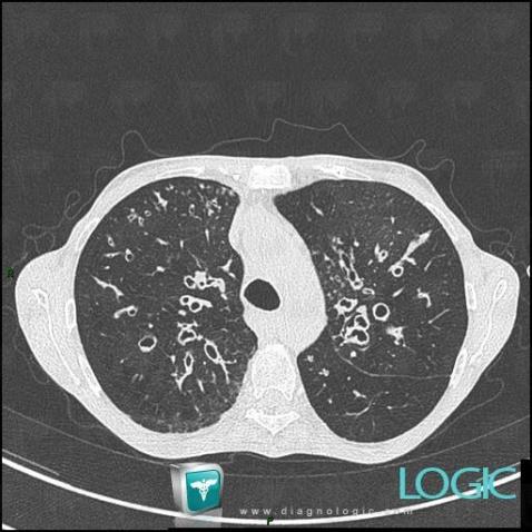 Mucoviscidose, Parenchyme pulmonaire, Scanner