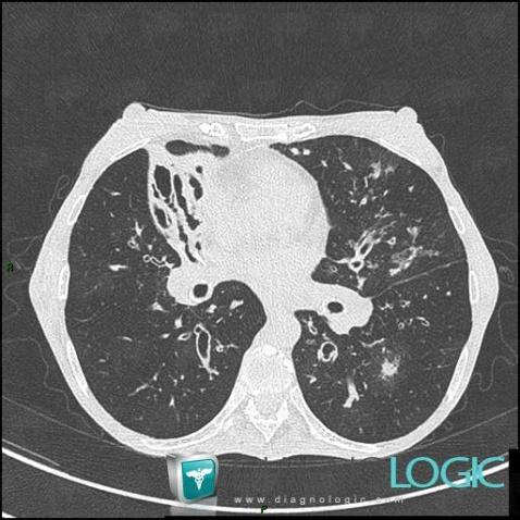Mucoviscidose, Parenchyme pulmonaire, Scanner