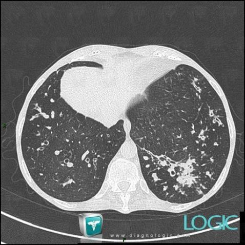Mucoviscidose, Parenchyme pulmonaire, Scanner