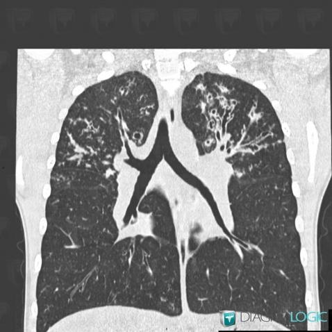 Mucoviscidose, Parenchyme pulmonaire, Scanner