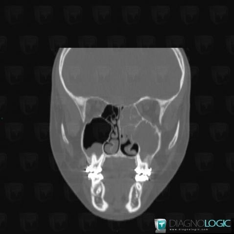 Mucus retention cyst, Sinus, CT