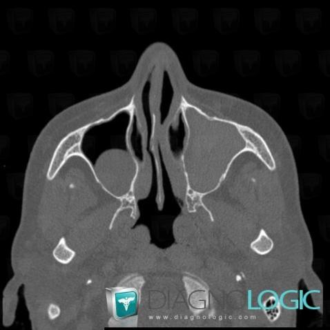 Mucus retention cyst, Sinus, CT