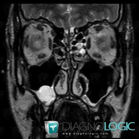 Mucus retention cyst, Sinus, MRI