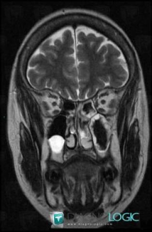 Mucus retention cyst, Sinus, MRI