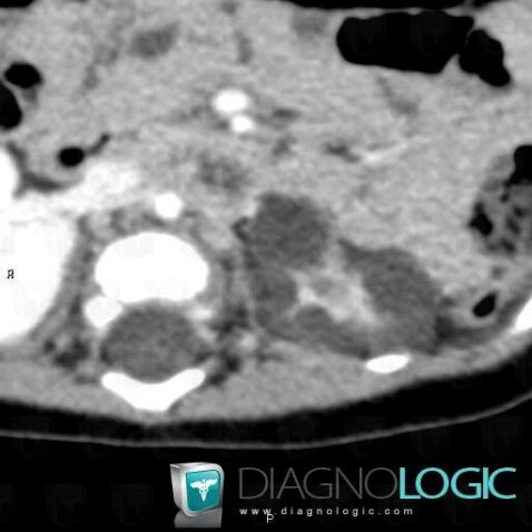 Multicystic dysplastic kidney, Kidney, CT