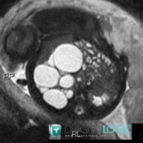 Multicystic dysplastic kidney, Kidney, MRI