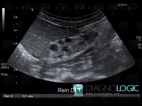 Multicystic dysplastic kidney, Kidney, US