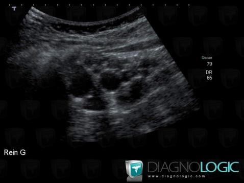 Multicystic dysplastic kidney, Kidney, US