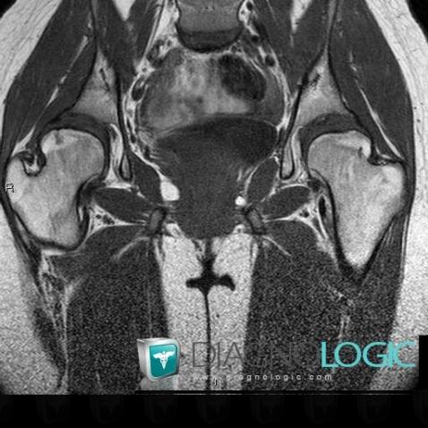 Multiple epiphyseal dysplasia, Femur - Proximal part, MRI