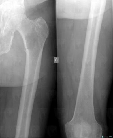 Multiple myeloma, Femur - Distal part, X rays