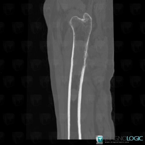 Multiple myeloma, Femur - Mid part, CT