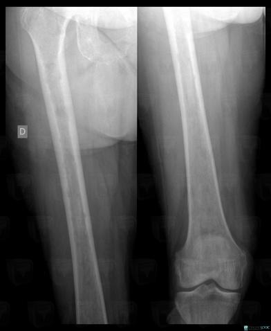 Multiple myeloma, Femur - Mid part, X rays