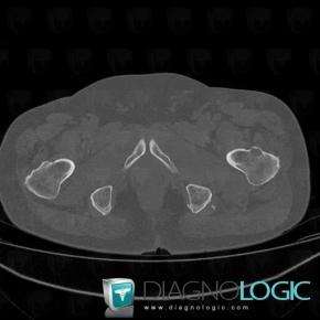 Multiple myeloma, Femur - Proximal part, CT