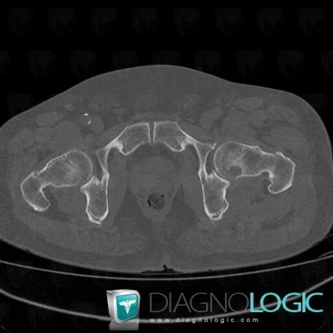 Multiple myeloma, Femur - Proximal part, CT