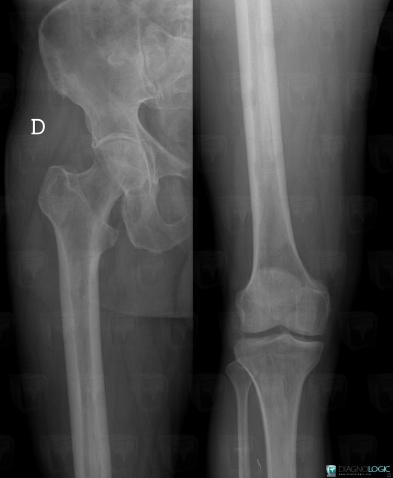 Multiple myeloma, Femur - Proximal part, X rays