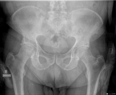 Multiple myeloma, Femur - Proximal part, X rays