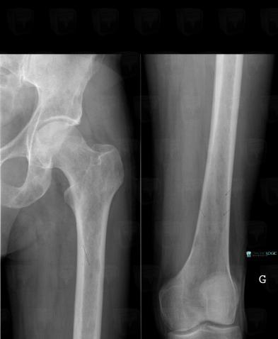 Multiple myeloma, Femur - Proximal part, X rays