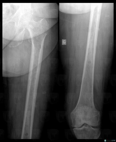 Multiple myeloma, Femur - Proximal part, X rays