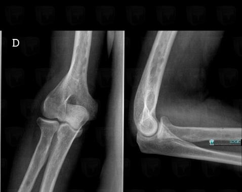 Multiple myeloma, Humerus - Distal part, X rays