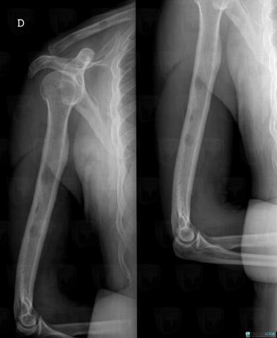 Multiple myeloma, Humerus - Mid part, X rays