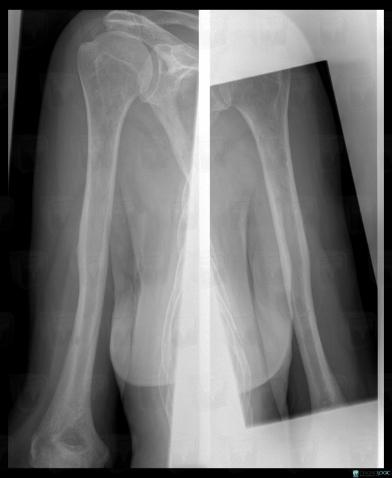 Multiple myeloma, Humerus - Mid part, X rays