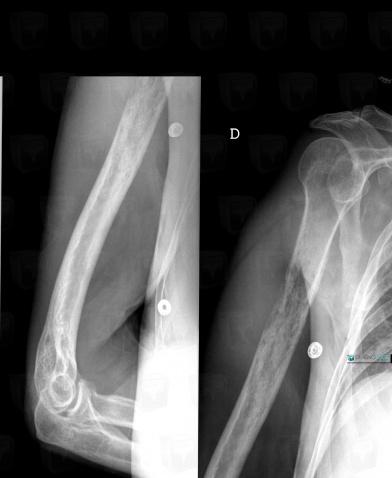 Multiple myeloma, Humerus - Mid part, X rays