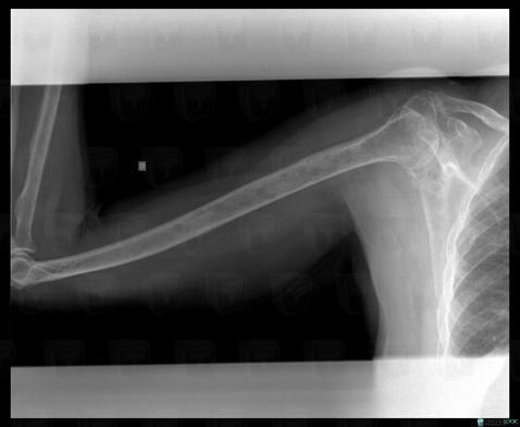 Multiple myeloma, Humerus - Mid part, X rays