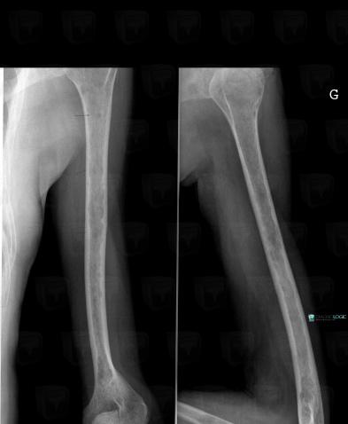 Multiple myeloma, Humerus - Proximal part, Humerus - Mid part, X rays