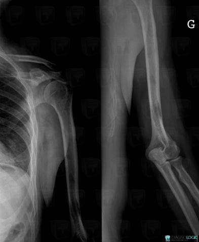 Multiple myeloma, Humerus - Proximal part, X rays