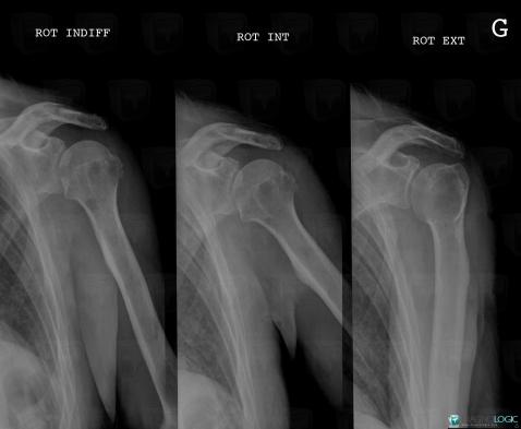 Multiple myeloma, Humerus - Proximal part, X rays