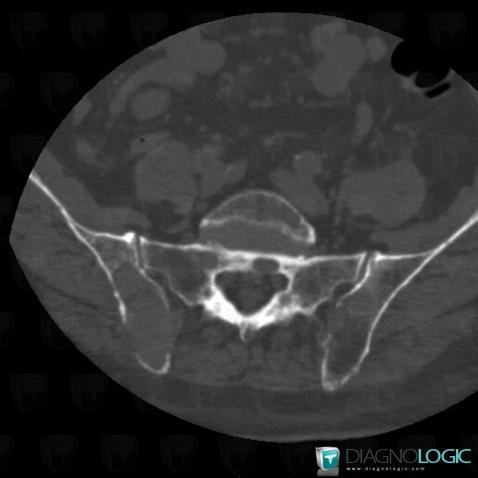 Multiple myeloma, Ilium, CT