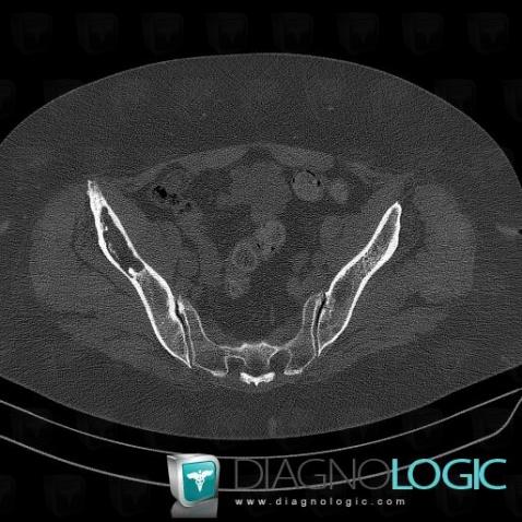 Multiple myeloma, Ilium, CT