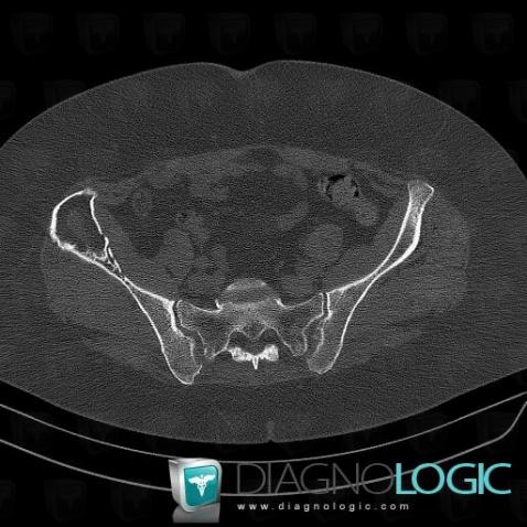 Multiple myeloma, Ilium, CT