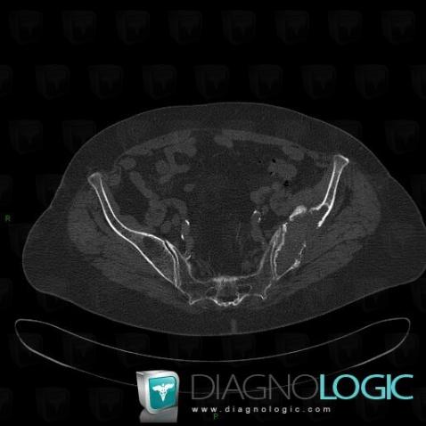 Multiple myeloma, Ilium, CT