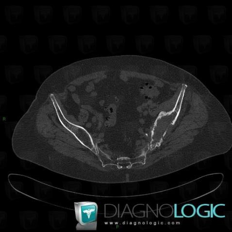 Multiple myeloma, Ilium, CT