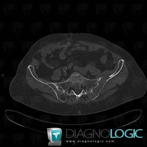 Multiple myeloma, Ilium, CT