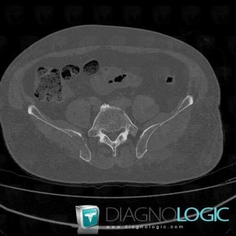 Multiple myeloma, Ilium, CT