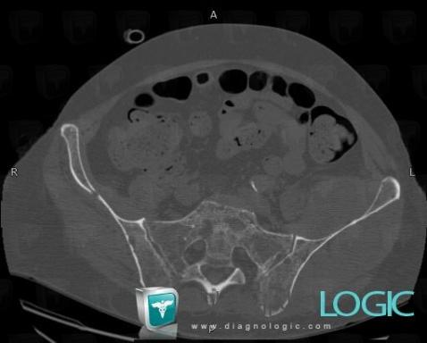 Multiple myeloma, Ilium, CT