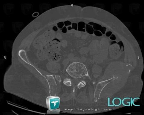 Multiple myeloma, Ilium, CT