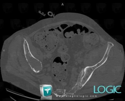 Multiple myeloma, Ilium, CT