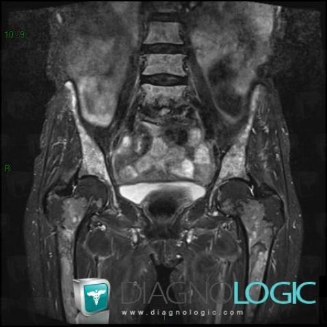 Multiple myeloma, Ilium, Femur - Proximal part, MRI