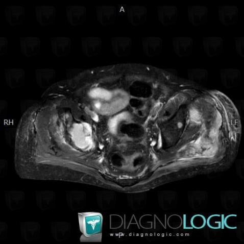 Multiple myeloma, Ilium, MRI